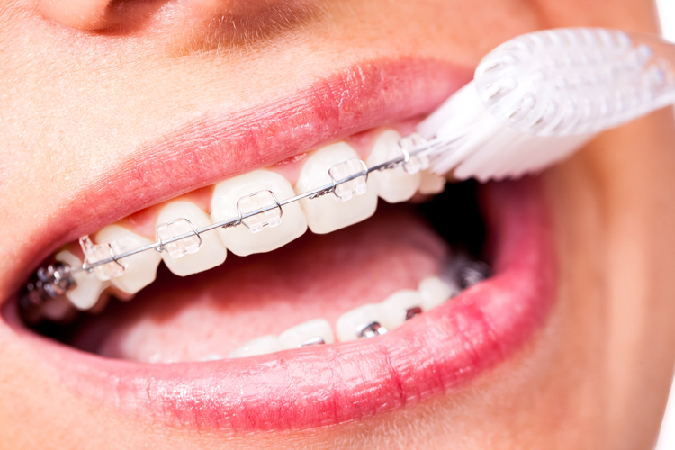 Chú ý chăm sóc vệ sinh răng miệng đúng cách để đảm bảo quá trình niềng răng mắc cài sứ được diễn ra liên tục và ổn định